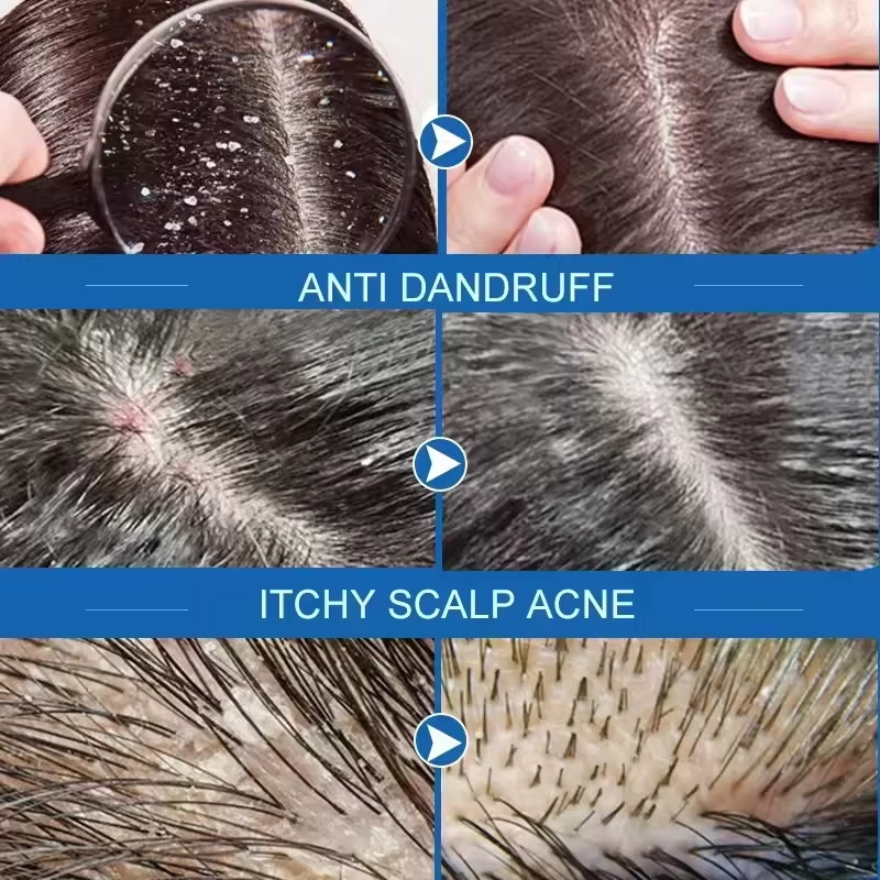 Fast Anti Dandruff Hair Treatm - Soap Making Unit review and price