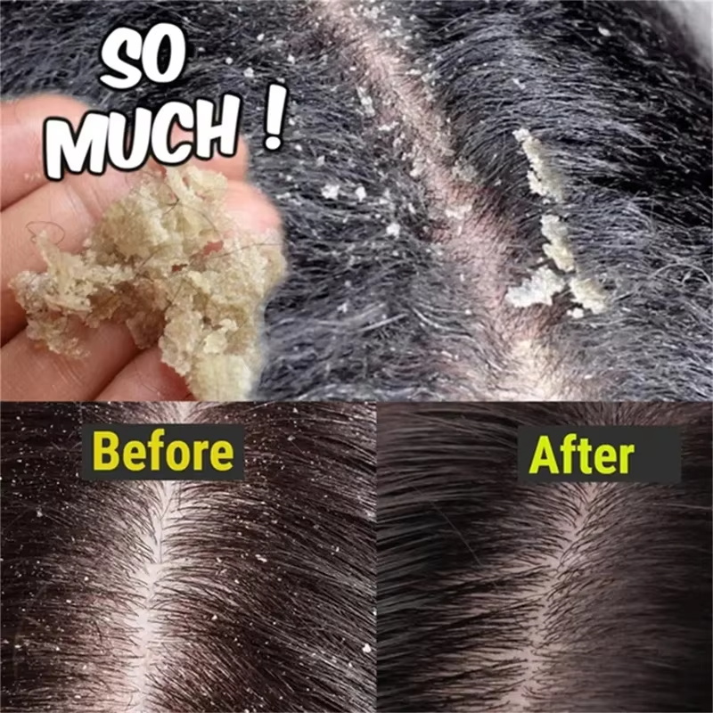 Fast Anti Dandruff Hair Treatm - Soap Making Unit review and price